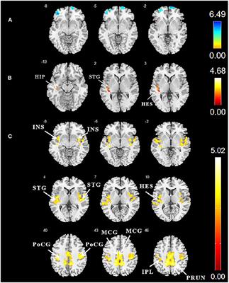 Altered Gray Matter Volume, Functional Connectivity, and Degree Centrality in Early-Onset Type 2 Diabetes Mellitus